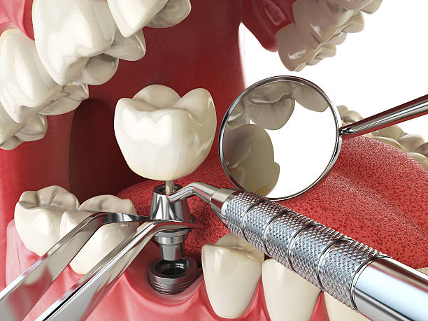 Best Emergency Cosmetic Dentistry (e.g., broken veneers) in Church Point, LA